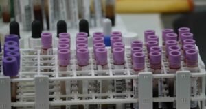 Una prueba genética de sangre identifica signos tempranos de recaída en melanoma Una prueba genética de sangre identifica signos tempranos de recaída en melanoma