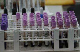 Una prueba genética de sangre identifica signos tempranos de recaída en melanoma Una prueba genética de sangre identifica signos tempranos de recaída en melanoma