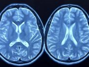 El estudio más grande de tejido cerebral afroamericano revela un gen crítico del Alzheimer El estudio más grande de tejido cerebral afroamericano revela un gen crítico del Alzheimer