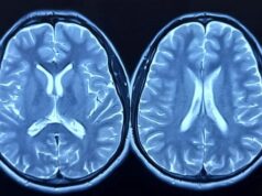 El estudio más grande de tejido cerebral afroamericano revela un gen crítico del Alzheimer El estudio más grande de tejido cerebral afroamericano revela un gen crítico del Alzheimer