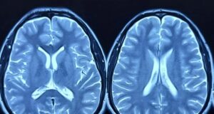 El estudio más grande de tejido cerebral afroamericano revela un gen crítico del Alzheimer El estudio más grande de tejido cerebral afroamericano revela un gen crítico del Alzheimer