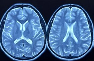 El estudio más grande de tejido cerebral afroamericano revela un gen crítico del Alzheimer El estudio más grande de tejido cerebral afroamericano revela un gen crítico del Alzheimer