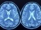 El estudio más grande de tejido cerebral afroamericano revela un gen crítico del Alzheimer El estudio más grande de tejido cerebral afroamericano revela un gen crítico del Alzheimer