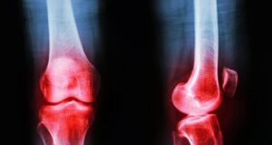 El tratamiento más efectivo contra la artrosis no son los medicamentos ni el quirófano El tratamiento más efectivo contra la artrosis no son los medicamentos ni el quirófano