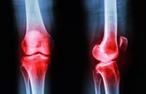 El tratamiento más efectivo contra la artrosis no son los medicamentos ni el quirófano El tratamiento más efectivo contra la artrosis no son los medicamentos ni el quirófano