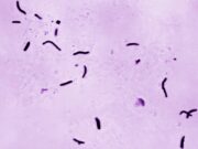 Detectado caso de tuberculosis en la escuela secundaria Grissom de Huntsville Detectado caso de tuberculosis en la escuela secundaria Grissom de Huntsville