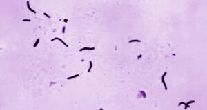 Detectado caso de tuberculosis en la escuela secundaria Grissom de Huntsville Detectado caso de tuberculosis en la escuela secundaria Grissom de Huntsville