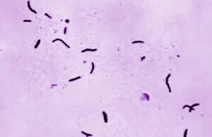 Detectado caso de tuberculosis en la escuela secundaria Grissom de Huntsville Detectado caso de tuberculosis en la escuela secundaria Grissom de Huntsville