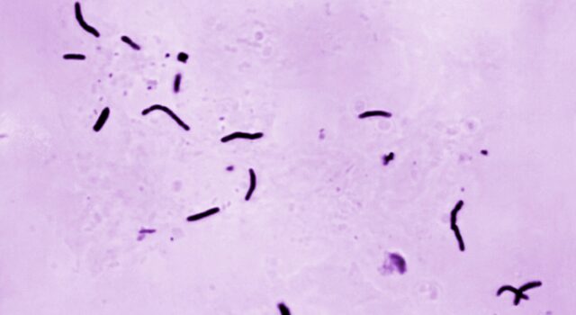 Detectado caso de tuberculosis en la escuela secundaria Grissom de Huntsville Detectado caso de tuberculosis en la escuela secundaria Grissom de Huntsville