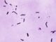 Detectado caso de tuberculosis en la escuela secundaria Grissom de Huntsville Detectado caso de tuberculosis en la escuela secundaria Grissom de Huntsville