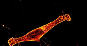 Descubrimiento sobre la propagación de la proteína tóxica en la enfermedad de Huntington Descubrimiento sobre la propagación de la proteína tóxica en la enfermedad de Huntington
