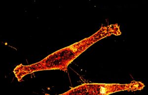 Descubrimiento sobre la propagación de la proteína tóxica en la enfermedad de Huntington Descubrimiento sobre la propagación de la proteína tóxica en la enfermedad de Huntington