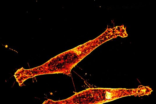 Descubrimiento sobre la propagación de la proteína tóxica en la enfermedad de Huntington Descubrimiento sobre la propagación de la proteína tóxica en la enfermedad de Huntington