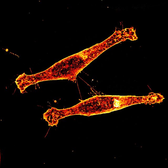 Hallan una nueva vía para intentar frenar la enfermedad de Huntington Descubrimiento sobre la propagación de la proteína tóxica en la enfermedad de Huntington