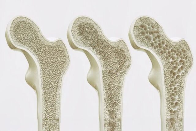 Científicos descubren receptor que fortalece huesos y revierte la osteoporosis
