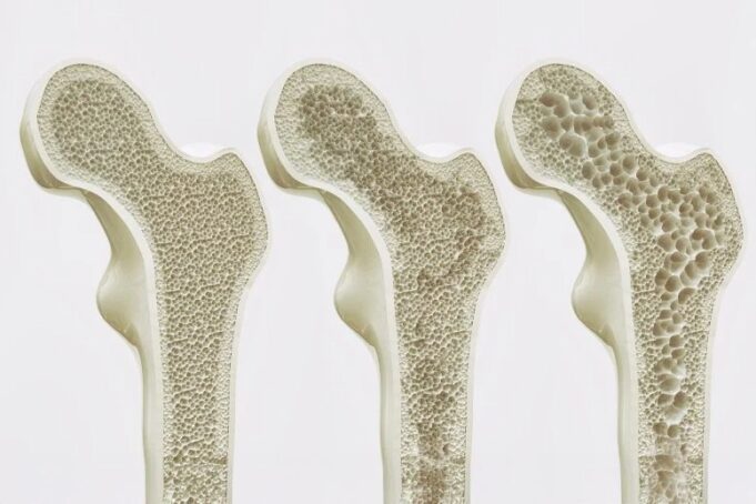 Científicos descubren receptor que fortalece huesos y revierte la osteoporosis Científicos descubren receptor que fortalece huesos y revierte la osteoporosis