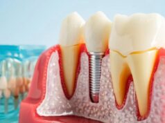 Salud dental: Descubren por qué fallan los implantes Modelo anatómico de prótesis y un implante dental de titanio colocado en el hueso maxilar y la encía.