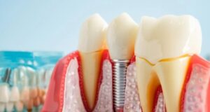 Salud dental: Descubren por qué fallan los implantes Modelo anatómico de prótesis y un implante dental de titanio colocado en el hueso maxilar y la encía.