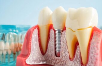 Salud dental: Descubren por qué fallan los implantes Modelo anatómico de prótesis y un implante dental de titanio colocado en el hueso maxilar y la encía.