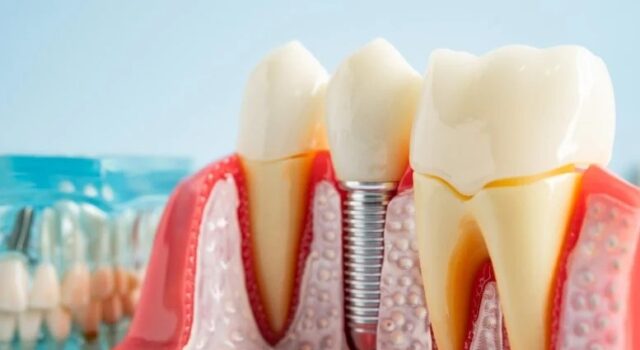 Salud dental: Descubren por qué fallan los implantes Modelo anatómico de prótesis y un implante dental de titanio colocado en el hueso maxilar y la encía.