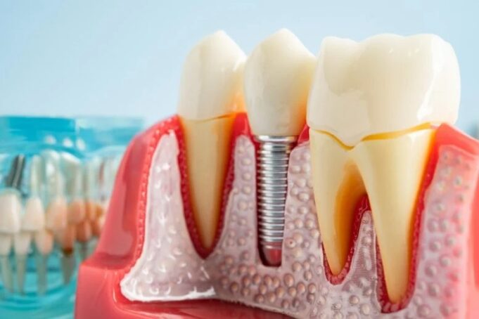 Salud dental: Descubren por qué fallan los implantes Modelo anatómico de prótesis y un implante dental de titanio colocado en el hueso maxilar y la encía.