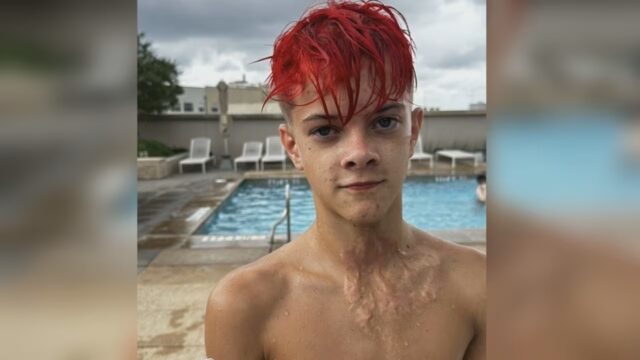 alabama-adolescente-quemaduras-reto-tiktok-needoh Joven con cabello rojo muestra cicatrices de quemaduras en su cuello provocadas por un juguete NeeDoh.