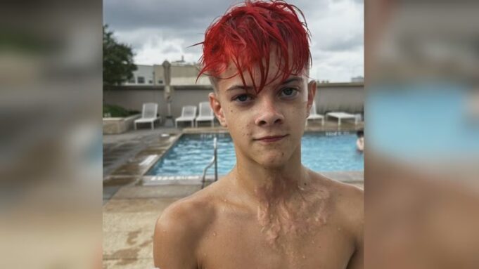 Reto de TikTok causa graves quemaduras con juguete NeeDoh Joven con cabello rojo muestra cicatrices de quemaduras en su cuello provocadas por un juguete NeeDoh.