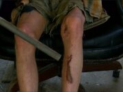 Cuatro adolescentes van a juicio por brutal golpiza en Ohatchee Víctima del ataque en Ohatchee sentado en una silla mostrando laceraciones y moretones en la pierna.
