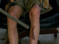 Cuatro adolescentes van a juicio por brutal golpiza en Ohatchee Víctima del ataque en Ohatchee sentado en una silla mostrando laceraciones y moretones en la pierna.