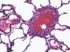 Ciclosporiasis desata alerta de viaje para mexicanos a EE. UU. Vista microscópica de una muestra celular teñida en tonos rosa y morado relacionada con la investigación de salud.
