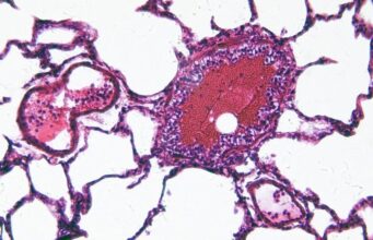 Ciclosporiasis desata alerta de viaje para mexicanos a EE. UU. Vista microscópica de una muestra celular teñida en tonos rosa y morado relacionada con la investigación de salud.