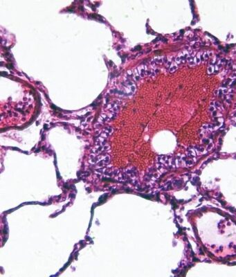Ciclosporiasis desata alerta de viaje para mexicanos a EE. UU. Vista microscópica de una muestra celular teñida en tonos rosa y morado relacionada con la investigación de salud.