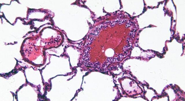 Ciclosporiasis desata alerta de viaje para mexicanos a EE. UU. Vista microscópica de una muestra celular teñida en tonos rosa y morado relacionada con la investigación de salud.