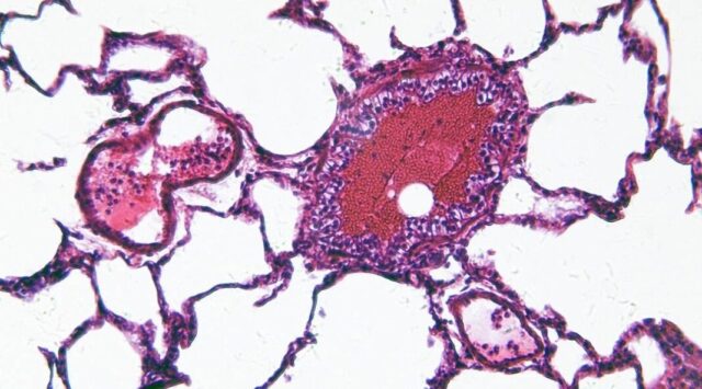Vista microscópica de una muestra celular teñida en tonos rosa y morado relacionada con la investigación de salud.