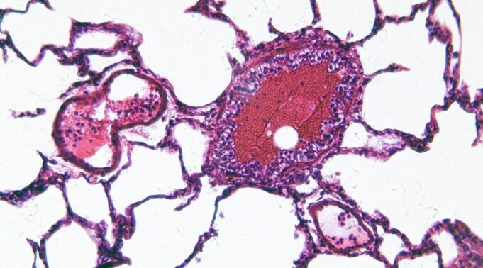 Ciclosporiasis desata alerta de viaje para mexicanos a EE. UU. Vista microscópica de una muestra celular teñida en tonos rosa y morado relacionada con la investigación de salud.