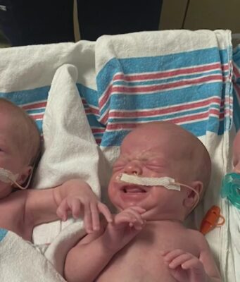 Trillizos Ivey en Huntsville celebran su primer año con salud Trillizos prematuros Ivey en la UCIN del Huntsville Hospital for Women & Children con tubos de alimentación y chupones.